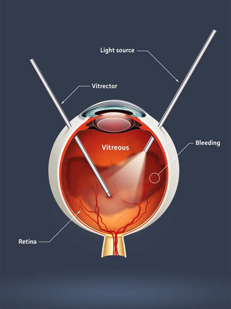 You will see a small bubble moving around the eye and it will blur your vision for a few days <b>after</b> surgery. . How long before i can fly after vitrectomy